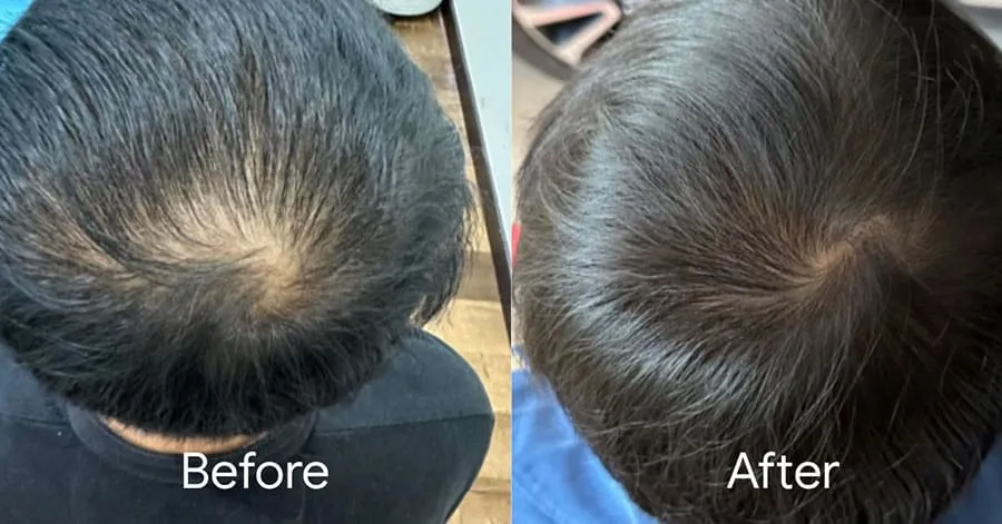 Two panels of a client's crown: visible thinning at the parting before, denser coverage after the microneedling programme