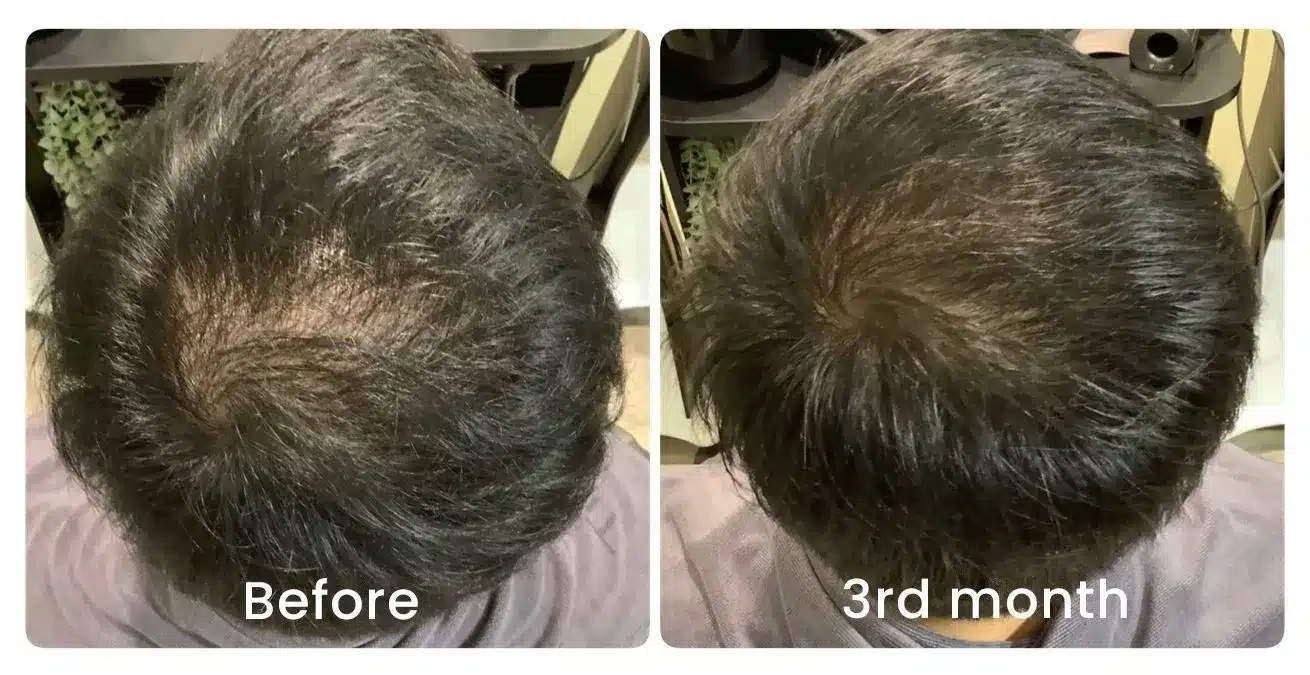 Hair loss treatment progress, before and after — crown density at month three