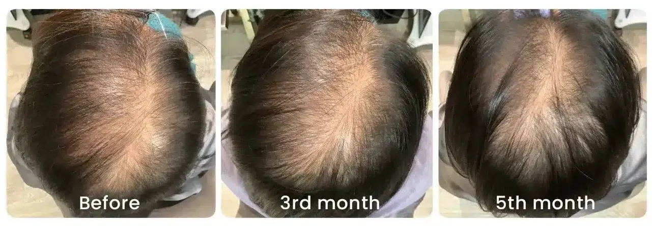 Hair loss treatment progress across three panels — before, third month, fifth month