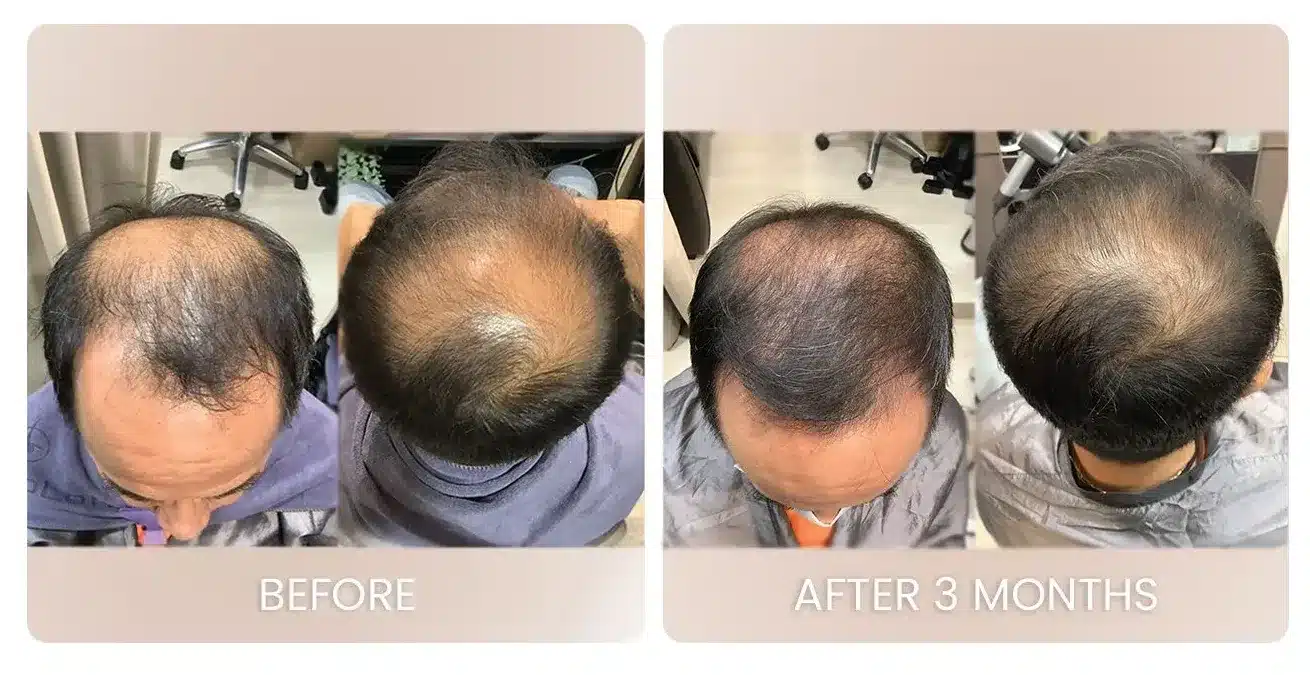 Hair loss treatment progress, before and after — hairline and parting at month three